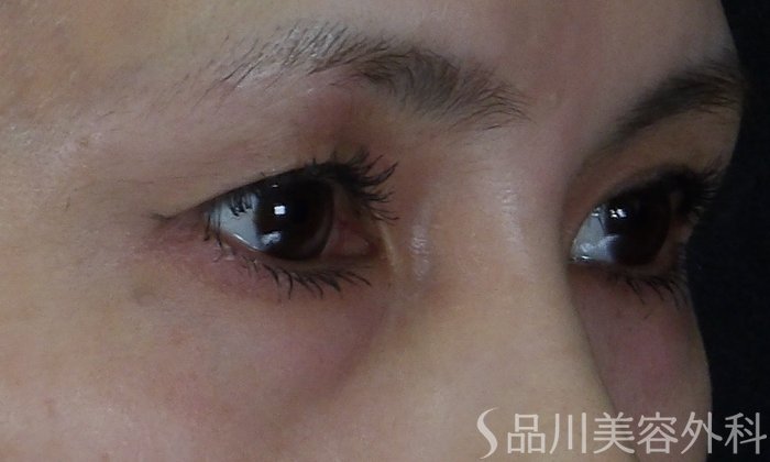 症例NO.70690のAFTER写真