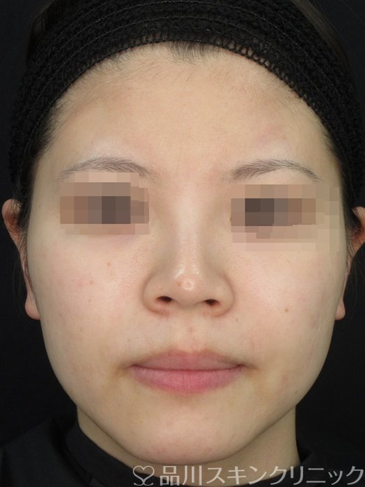 症例NO.73122のAFTER写真