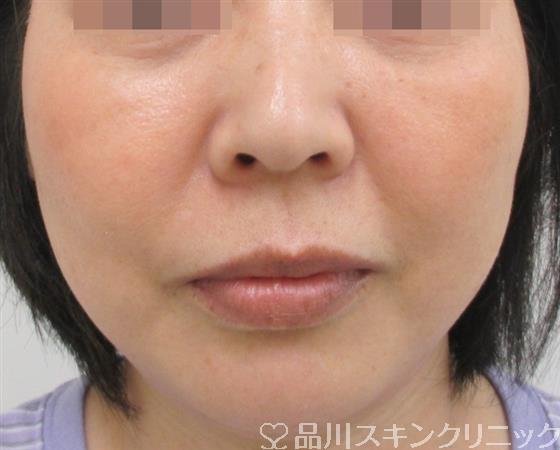 症例NO.27602のAFTER写真