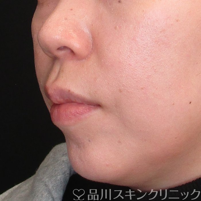 症例NO.73050のBEFORE写真