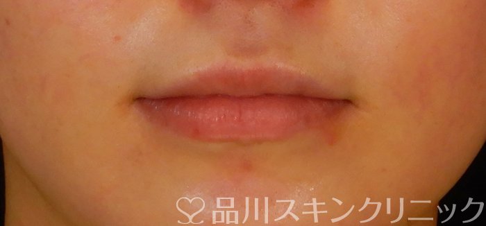 症例NO.66221のBEFORE写真