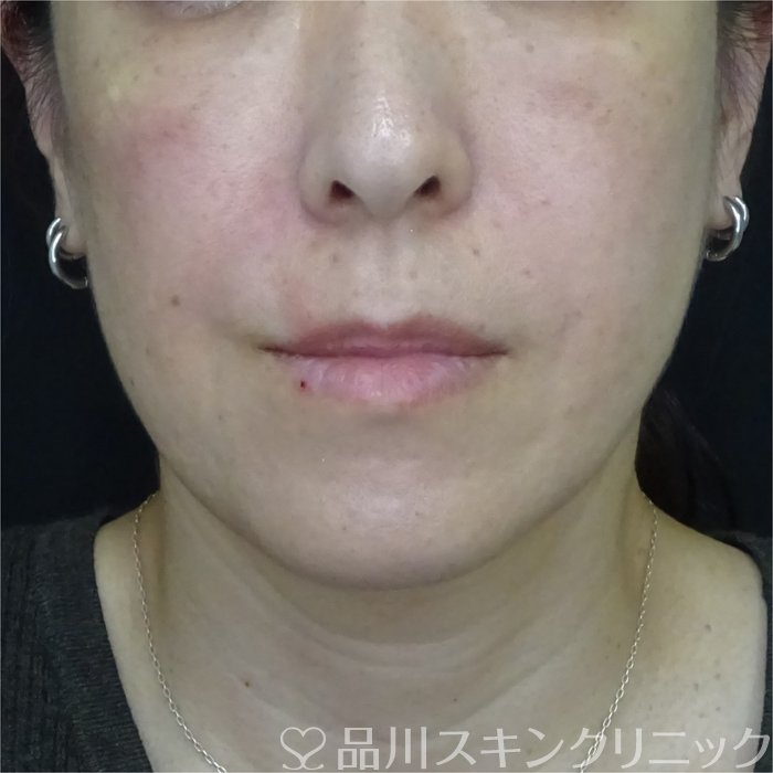 症例NO.71988のAFTER写真