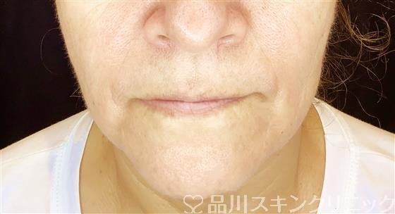 症例NO.61354のBEFORE写真