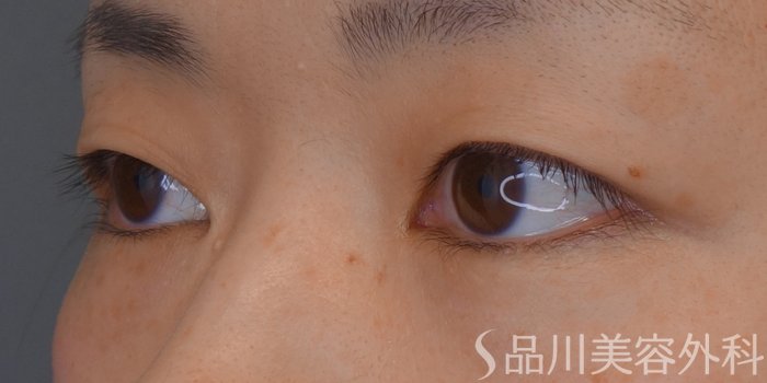 症例NO.72320のBEFORE写真