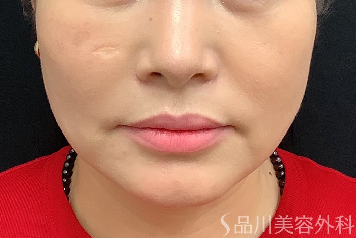 症例NO.73320のAFTER写真