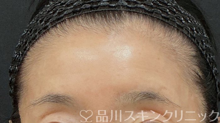 症例NO.74401のBEFORE写真