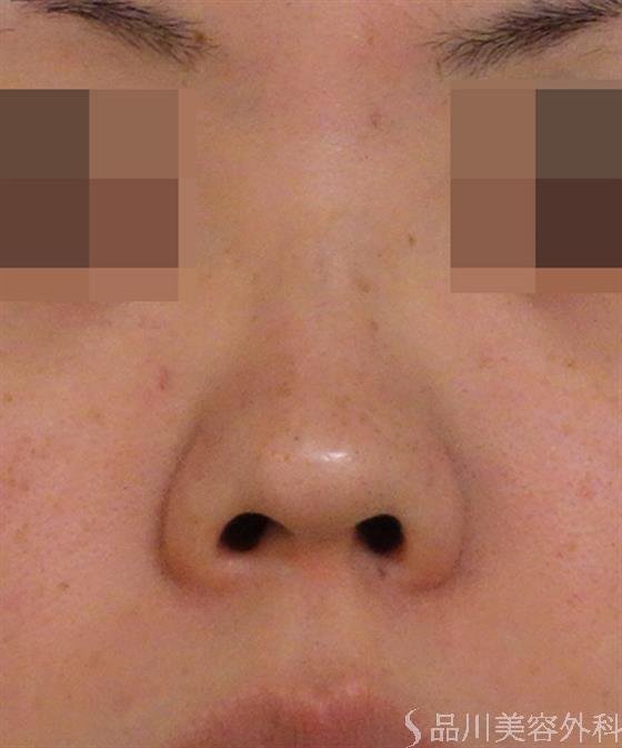 症例NO.40101のBEFORE写真