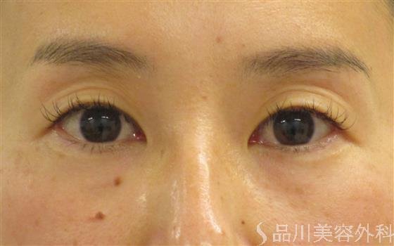 症例NO.50567のBEFORE写真