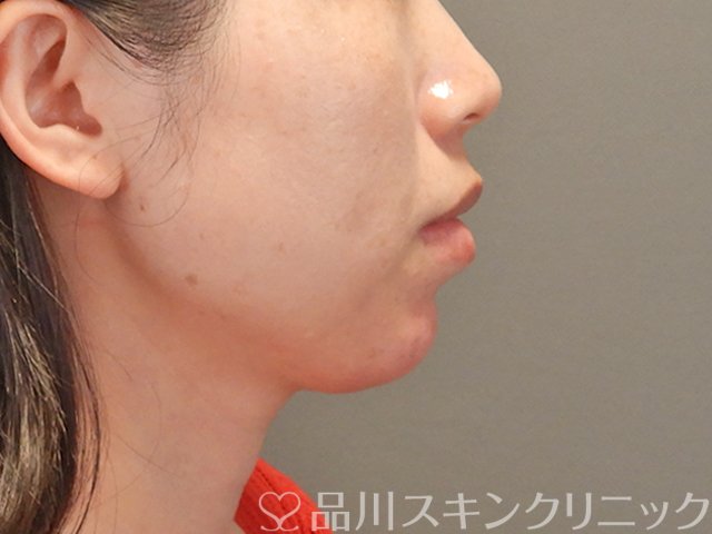 症例NO.75063のAFTER写真