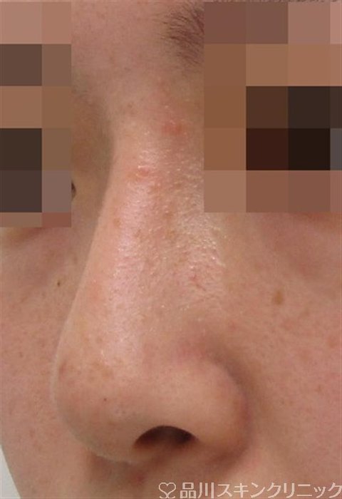 症例NO.38833のAFTER写真