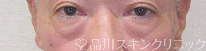 症例NO.70679のBEFORE写真