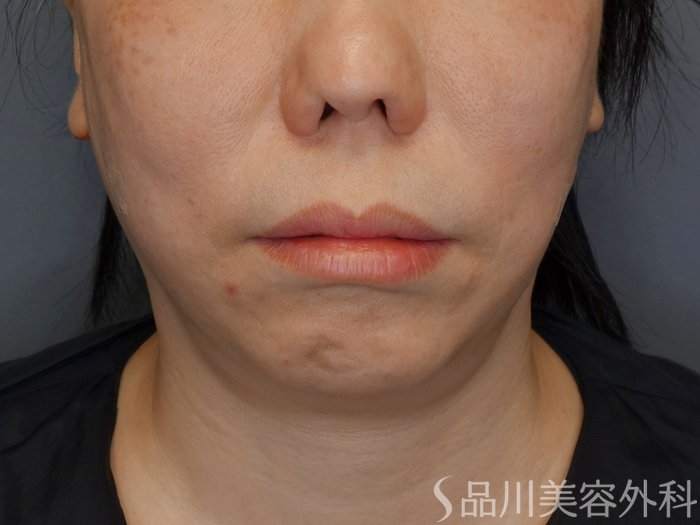 症例NO.72987のAFTER写真