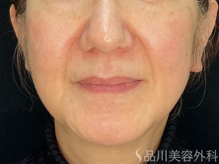 症例NO.72660のBEFORE写真