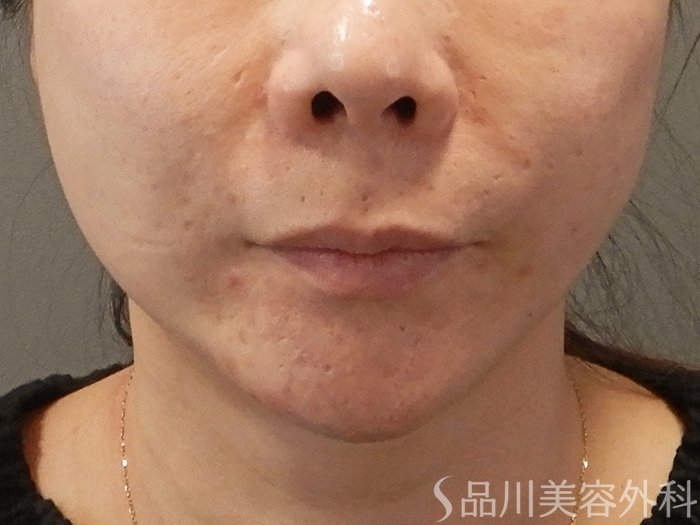 症例NO.70206のBEFORE写真