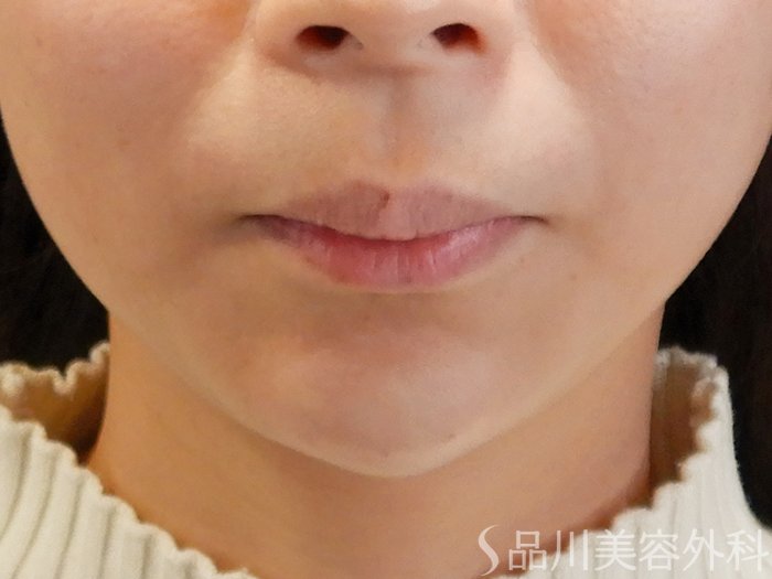 症例NO.69730のAFTER写真