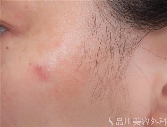 症例NO.56275のAFTER写真