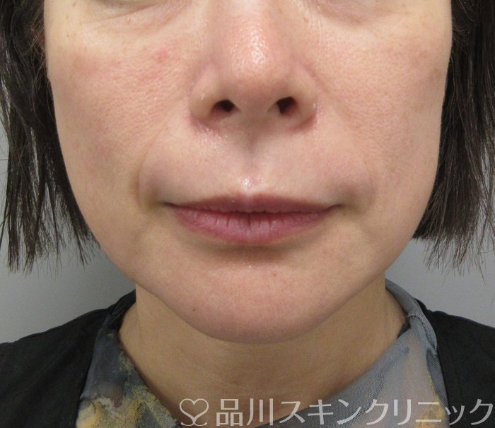 症例NO.74579のBEFORE写真