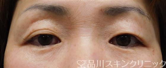 症例NO.48110のBEFORE写真