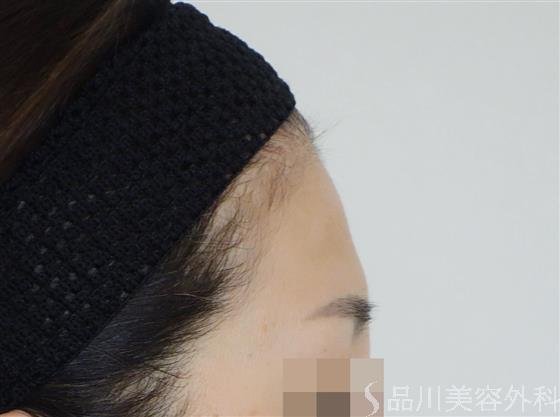 症例NO.49464のBEFORE写真