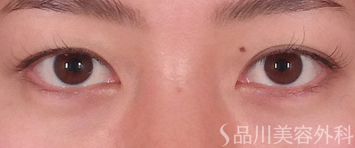 症例NO.70256のBEFORE写真