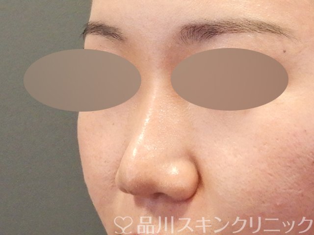 症例NO.64721のAFTER写真