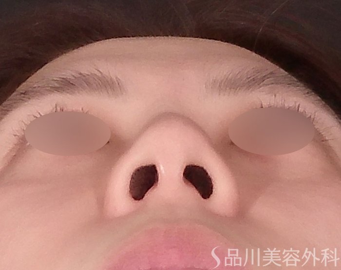 症例NO.70471のBEFORE写真