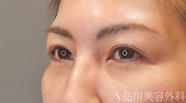 症例NO.75297のBEFORE写真