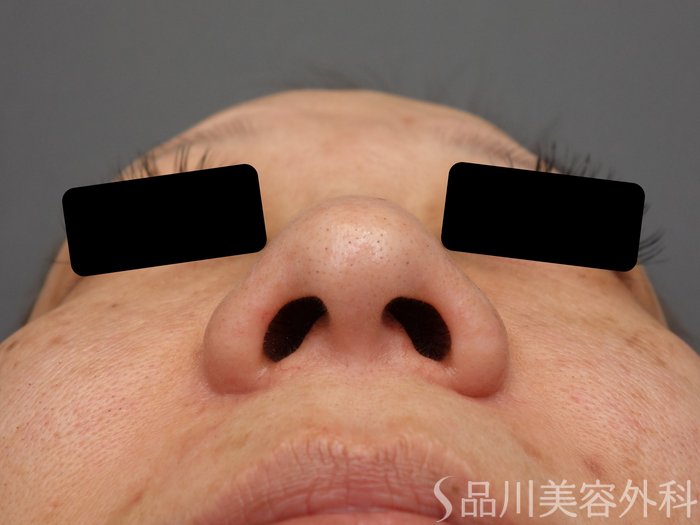 症例NO.74290のBEFORE写真