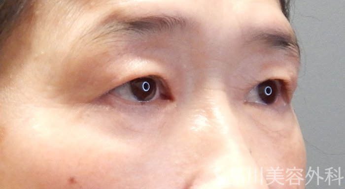 症例NO.70528のAFTER写真
