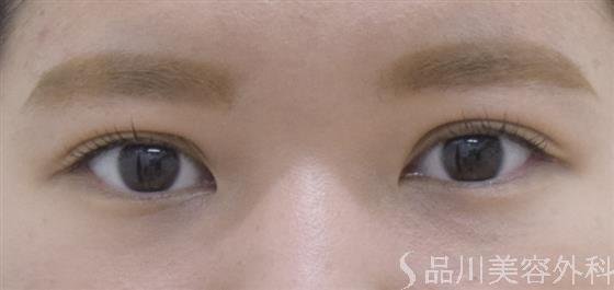 症例NO.52539のAFTER写真