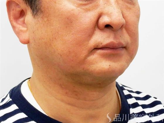 症例NO.55726のBEFORE写真