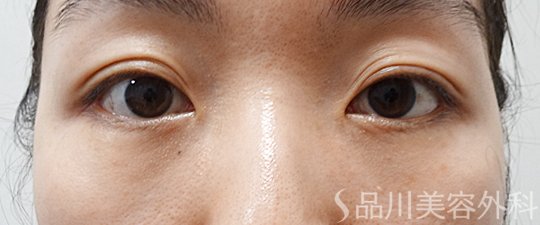 症例NO.69882のAFTER写真