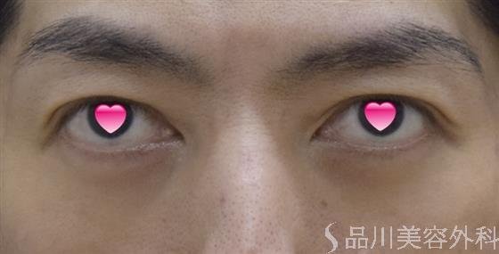 症例NO.51670のAFTER写真