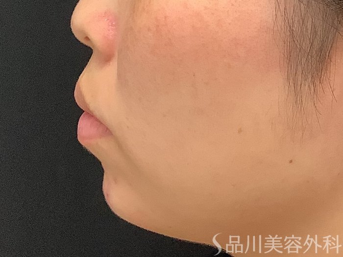 症例NO.67893のAFTER写真