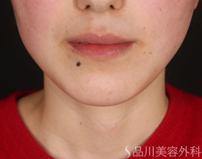 症例NO.73250のAFTER写真