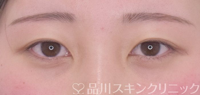 症例NO.65406のBEFORE写真