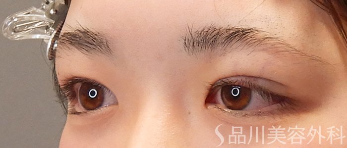 症例NO.69305のAFTER写真