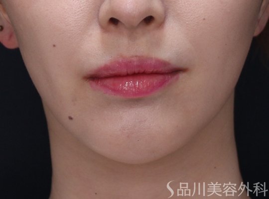 症例NO.71719のAFTER写真