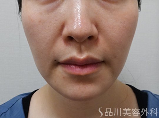 症例NO.75175のBEFORE写真
