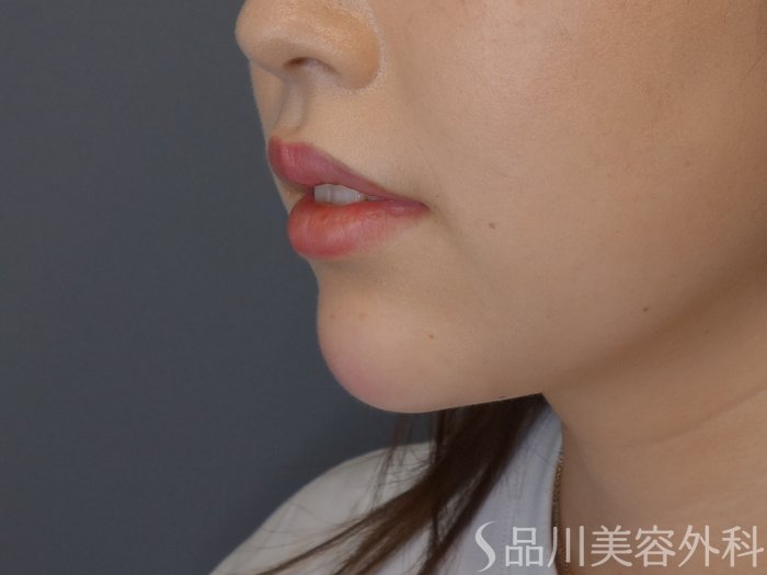 症例NO.71056のAFTER写真