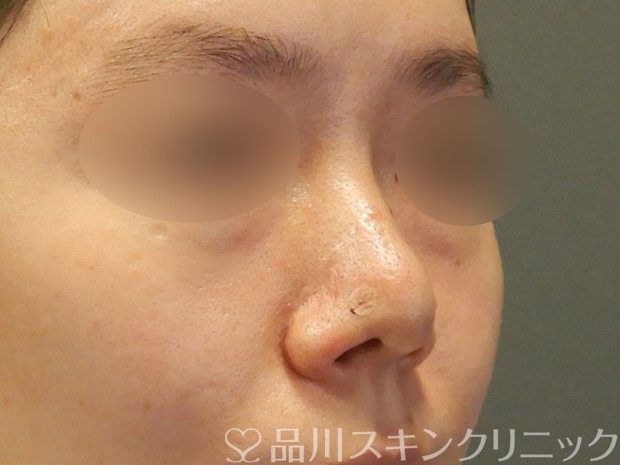 症例NO.70098のAFTER写真
