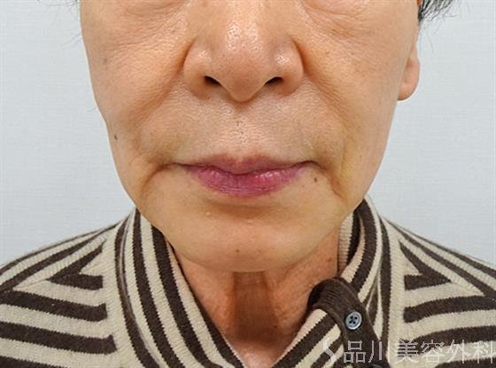 症例NO.51115のBEFORE写真
