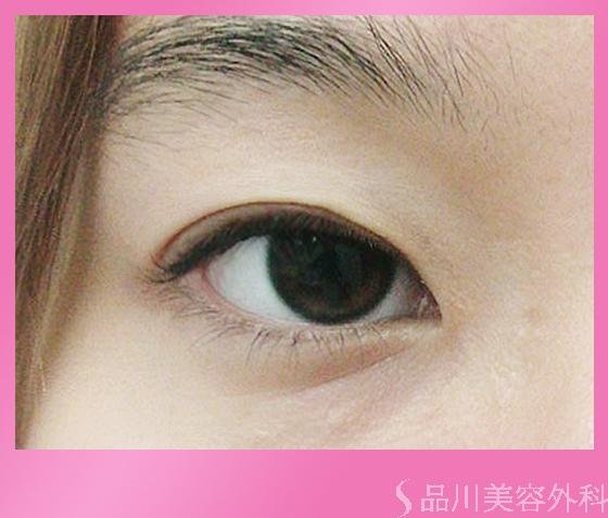 症例NO.822のAFTER写真