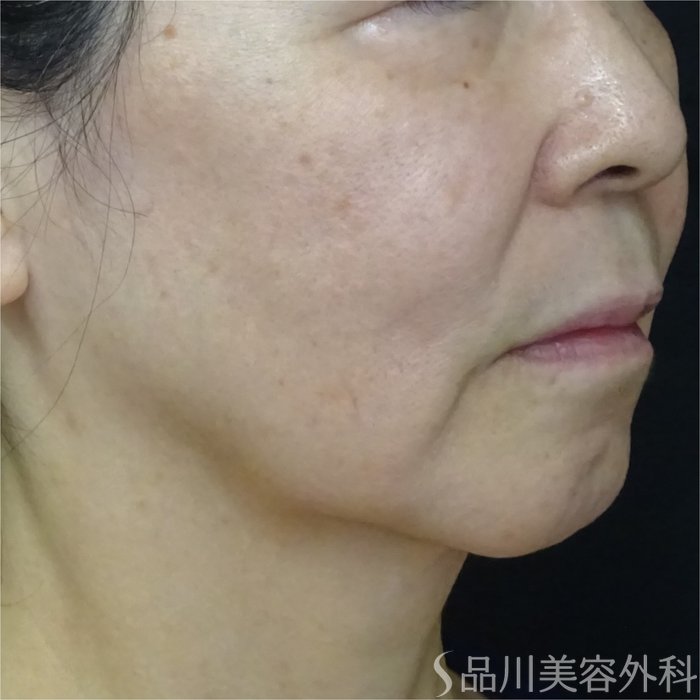 症例NO.68250のBEFORE写真