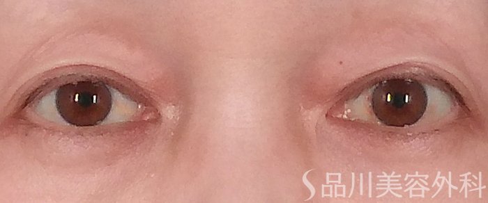 症例NO.69940のBEFORE写真