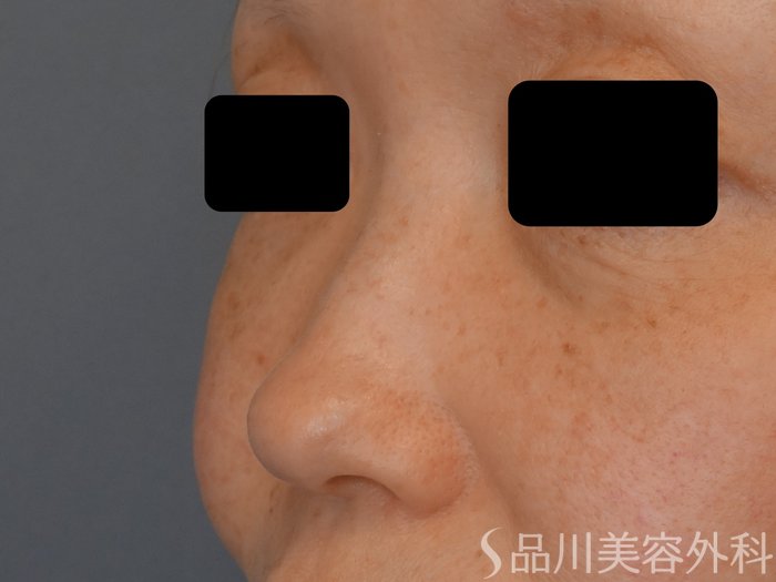 症例NO.69629のBEFORE写真
