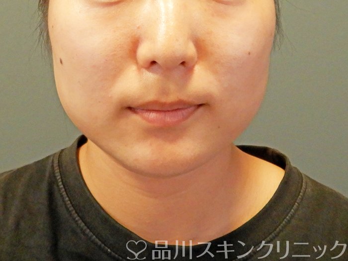 症例NO.66685のBEFORE写真