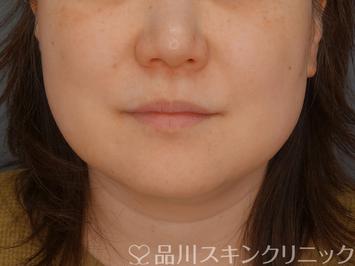 症例NO.72994のBEFORE写真