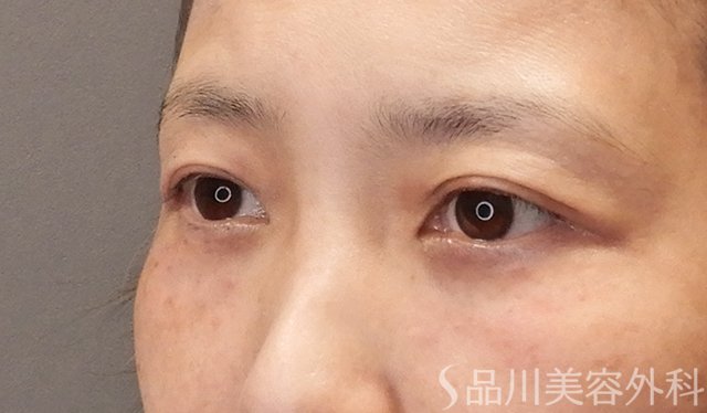 症例NO.75041のAFTER写真