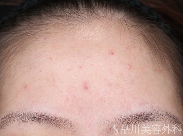 症例NO.74633のBEFORE写真